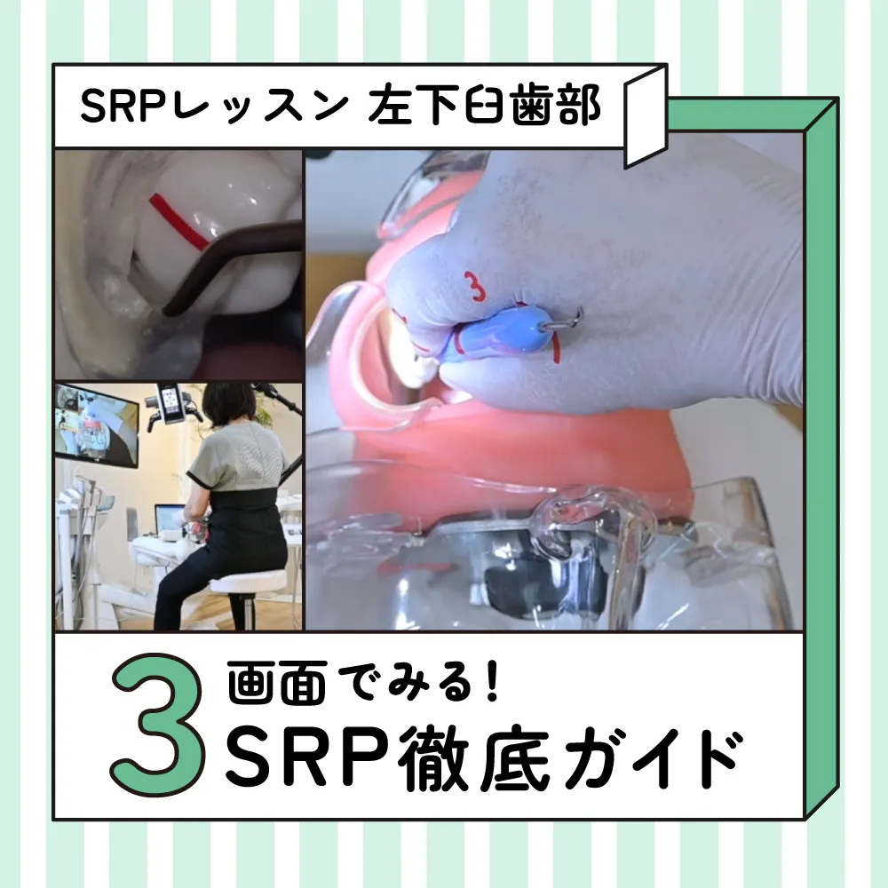 SRPレッスン 左下臼歯部