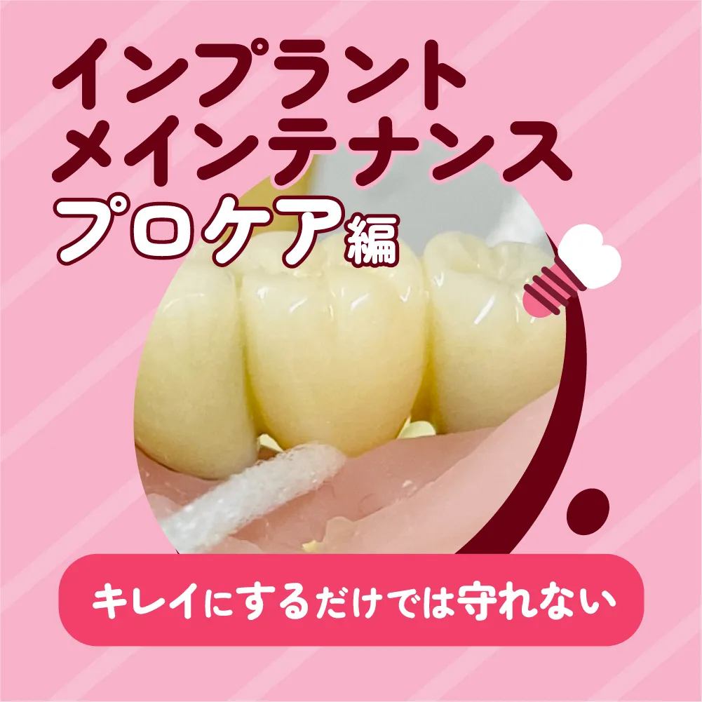 インプラントメインテナンス -プロケア編-