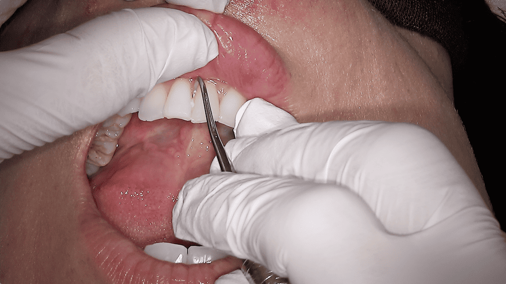 シックルスケーラー