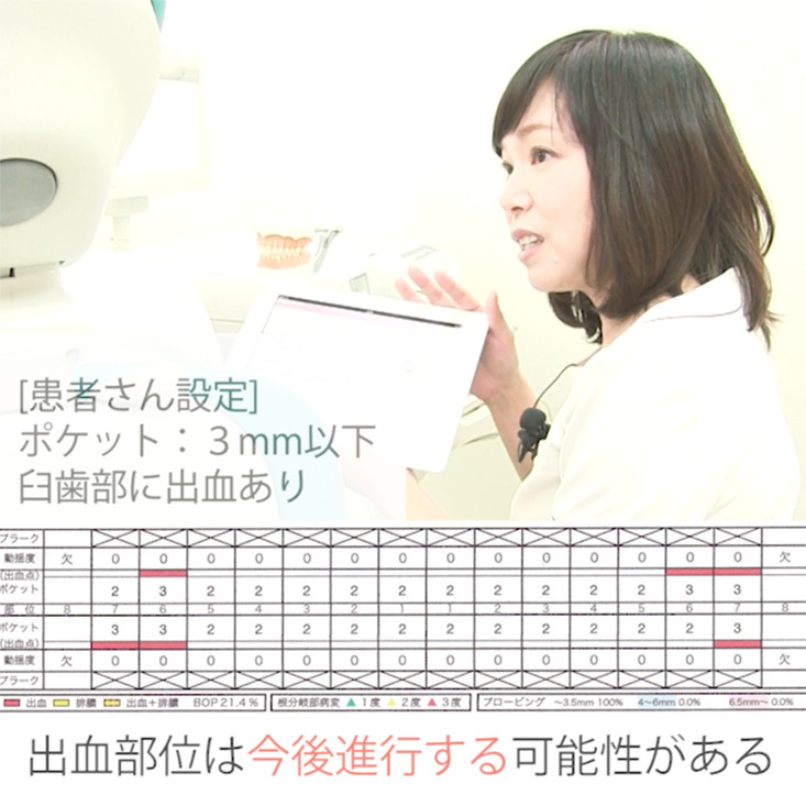 コミュニケーション 〜患者さんへの伝え方〜 04. 基本検査後の説明 歯肉炎 その1