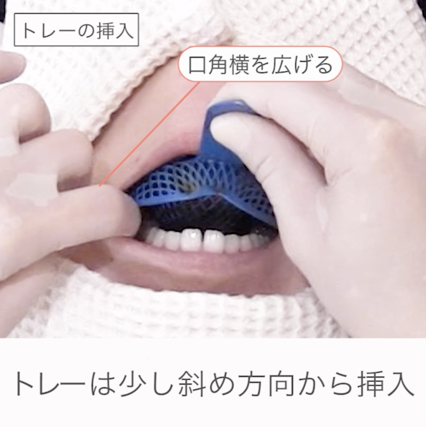 01.印象用トレーの試適