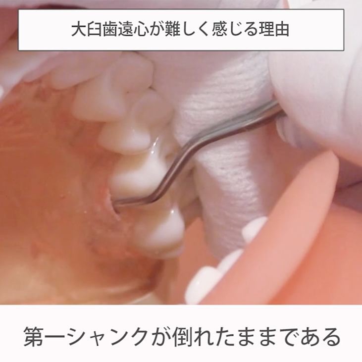 動画 苦手をなくそうsrp 実践編 12 左上6口蓋側遠心 歯科衛生士のための無料動画学習サイト ラプレッスン