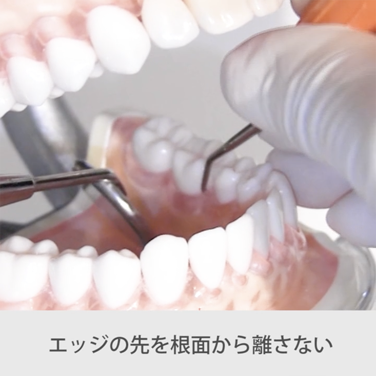 苦手をなくそうSRP 実践編左下６舌側近心 