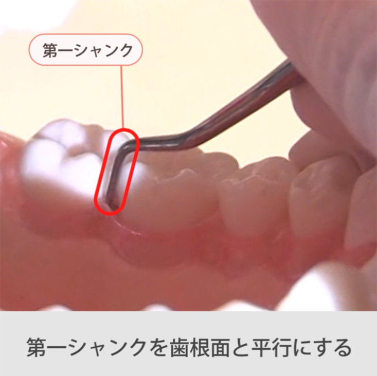 苦手をなくそうSRP 左下6舌側遠心 