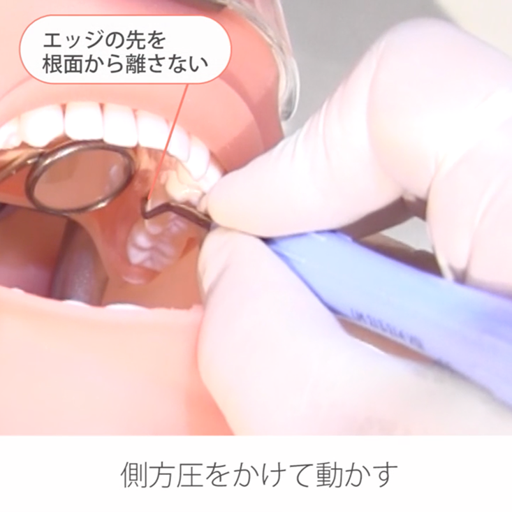 苦手をなくそうSRP 右下6舌側遠心心 