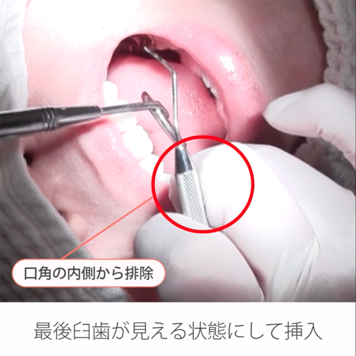 基本検査 実践編 05.こんな場合どうする？右上最後臼歯部