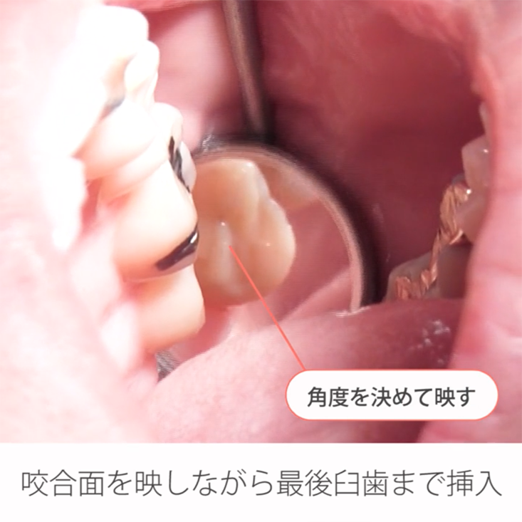 基本検査 実践編 06.こんな時どうする？左上最後臼歯部