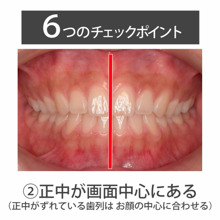 仰臥位で撮る口腔内写真５枚法 02.正面観の撮影チェックポイント