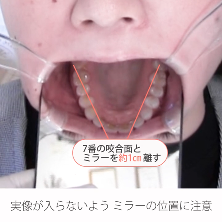 仰臥位で撮る口腔内写真５枚法 09.上顎咬合面観撮影ポジションと手順