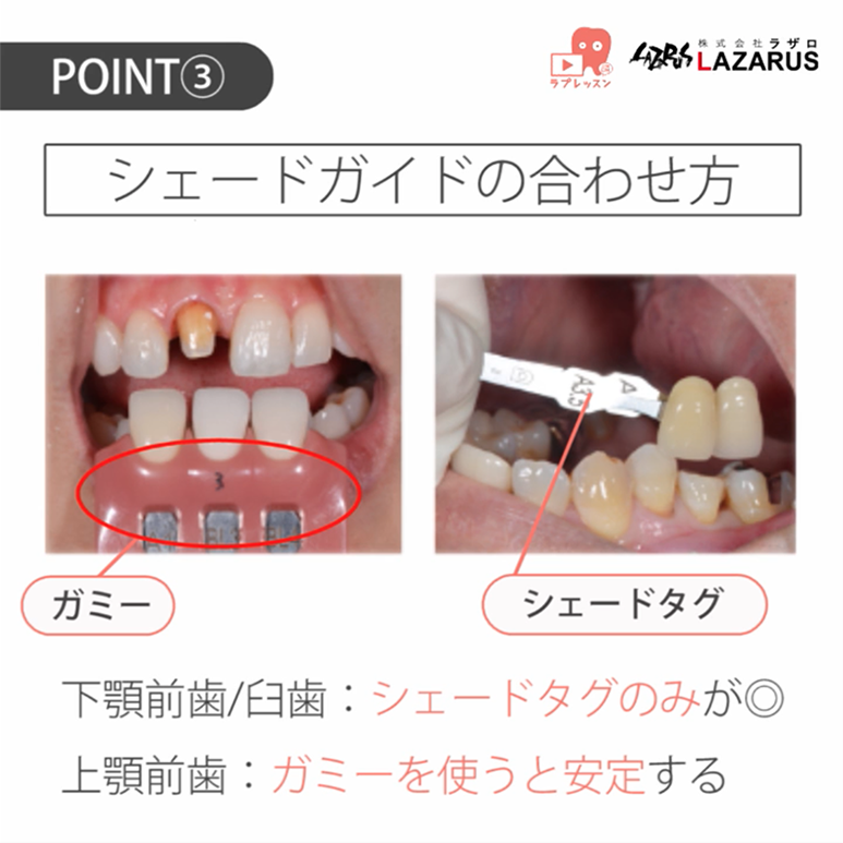 歯科技工 05.シェードテイクの方法~前半~