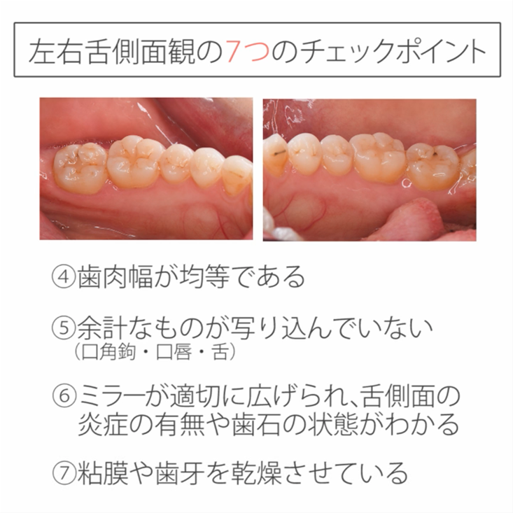 仰臥位で撮る口腔内写真12枚法 03.舌側・口蓋側・側面観のチェックポイント