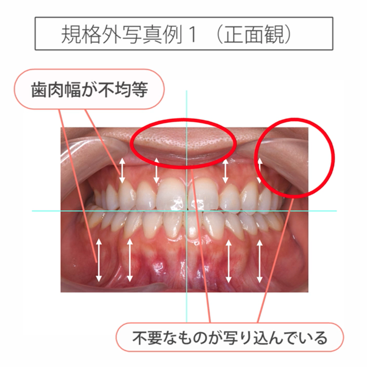 仰臥位で撮る口腔内写真５枚法 11.規格外写真とその対策（正面観）