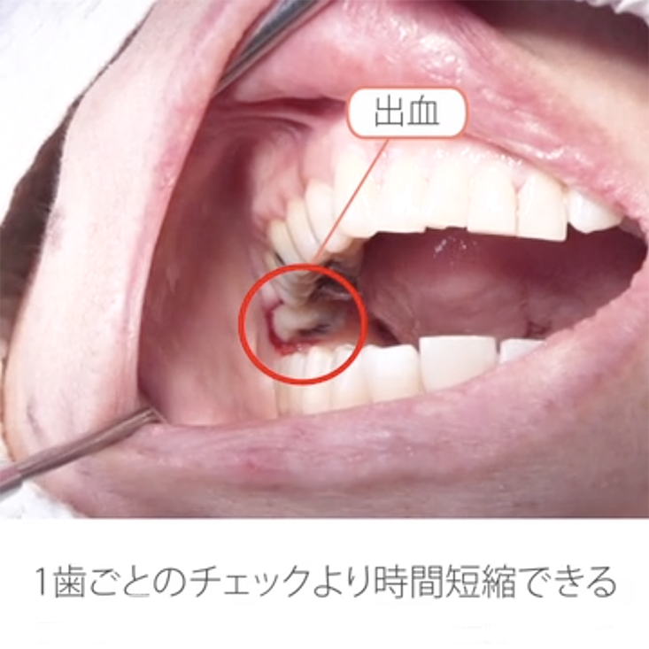 “困った”を解決するワンポイントアドバイス 15.スピードアップしよう！歯周組織検査