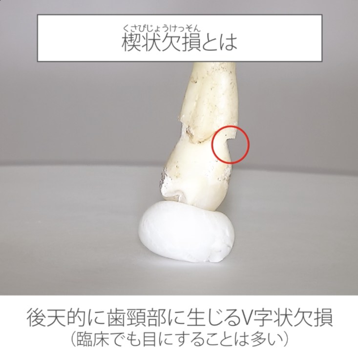 やさしい解剖学 07.楔状欠損