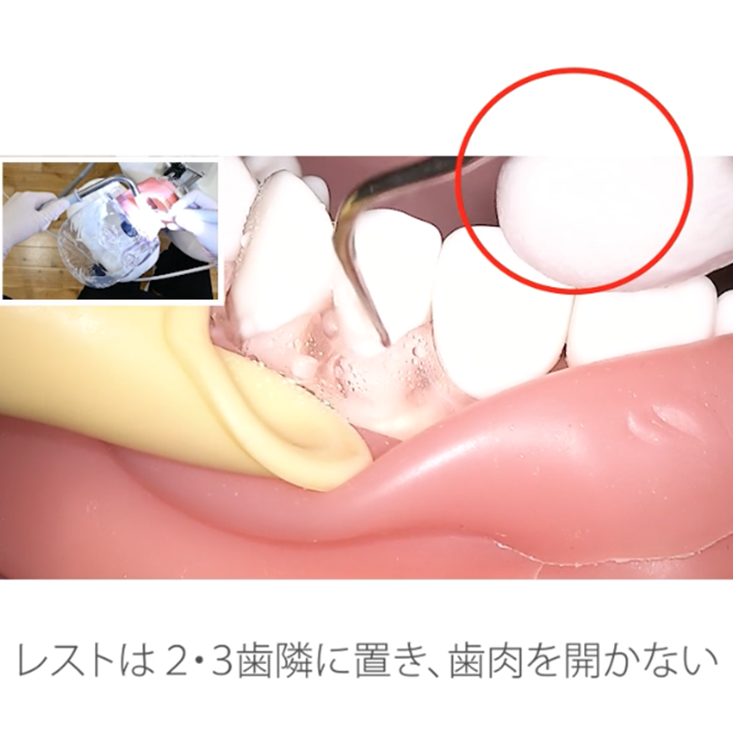 スケーリング実践編 リニューアル版 10.左上臼歯部頬側〜前歯部唇側その2