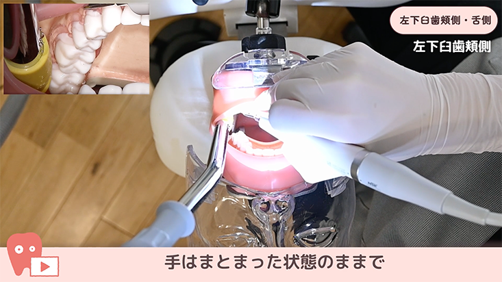 01.左下臼歯部頬側・舌側