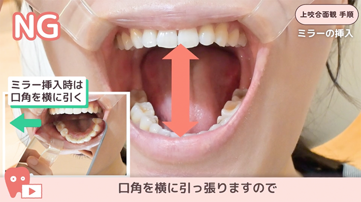 座位で撮る口腔内写真５枚法 10.上顎咬合面観　手順