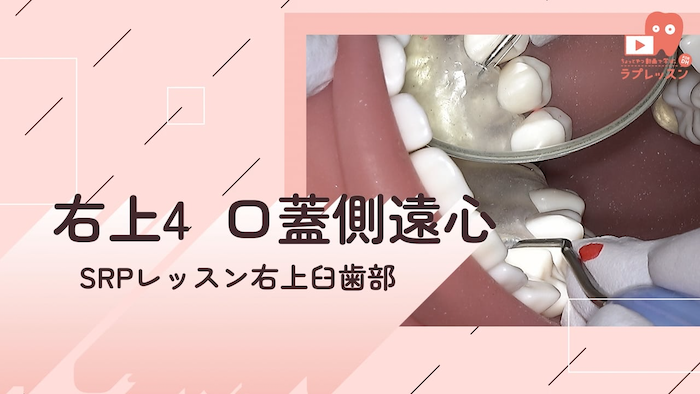 SRPレッスン 右上臼歯部 07.右上4_口蓋側/遠心