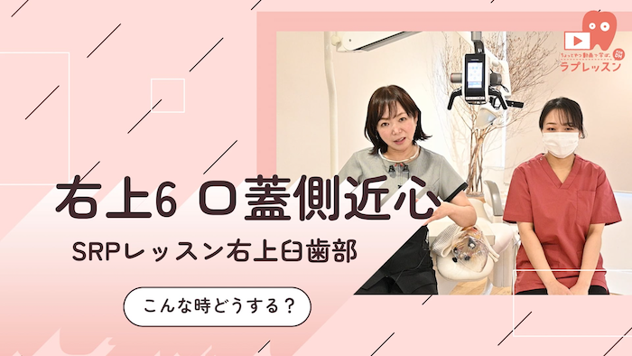 SRPレッスン 右上臼歯部 11.こんな時どうする？-右上6_口蓋側/近心-