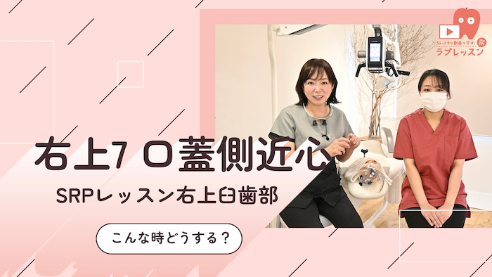 SRPレッスン 右上臼歯部 19.こんな時どうする？-右上7_口蓋側/近心-