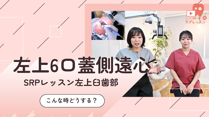 SRPレッスン 左上臼歯部 13.こんな時どうする？-左上6_口蓋側/遠心-