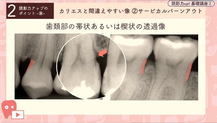 読影力up！基礎講座 02.読影力アップのためのポイント-歯編-