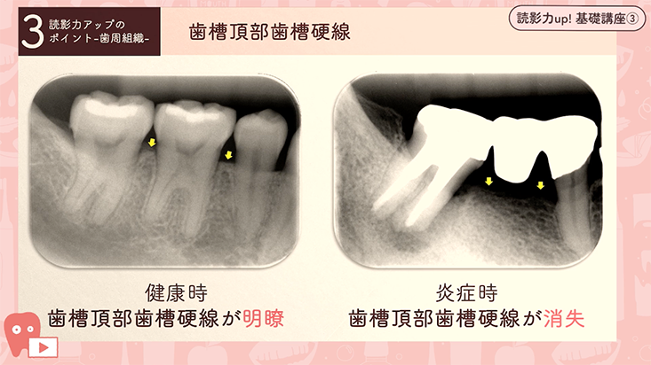 読影力up！基礎講座 03.読影力アップのポイント-歯周組織編-