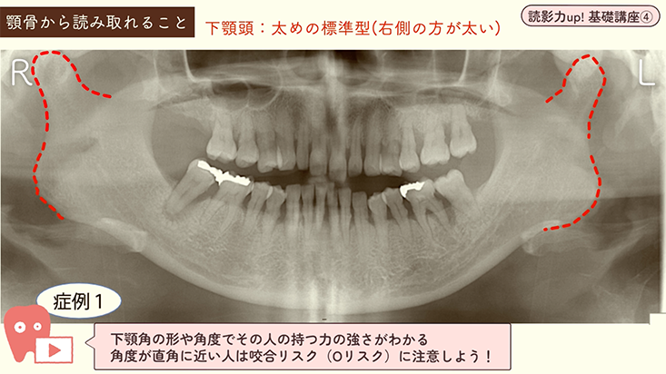 読影力up！基礎講座 04.読影力トレーニング＆読影力アップを実感