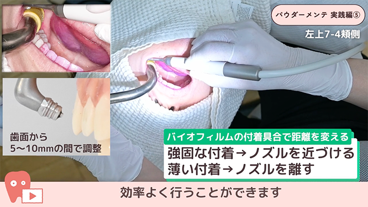 パウダーメインテナンス 実践編 05.左上臼歯部