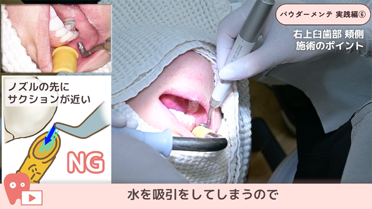 パウダーメインテナンス 実践編 06.上顎前歯部から右上臼歯部 その１