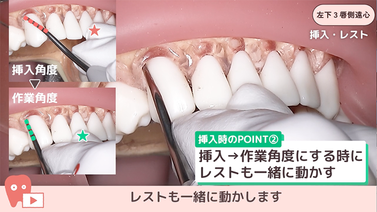 ☆SRPレッスン 下顎前歯部 ☆05.左下３唇側遠心