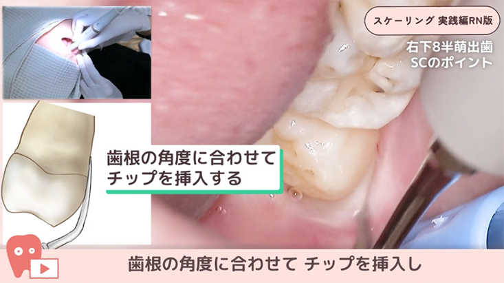スケーリング実践編 リニューアル版 13.症例でみる！右下８半萌出のスケーリング