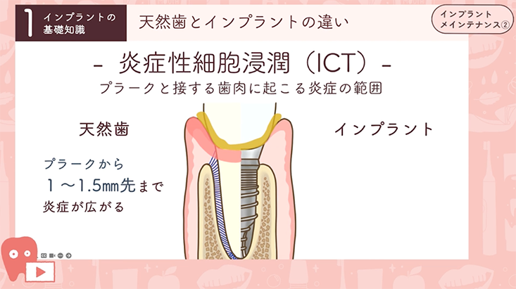 インプラントメインテナンス"