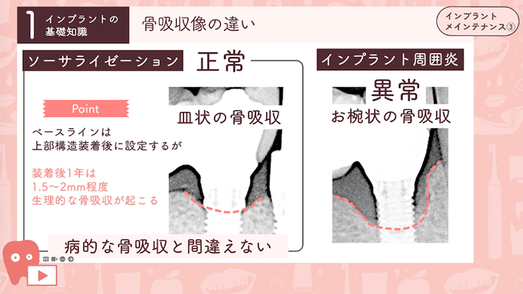インプラントメインテナンス"