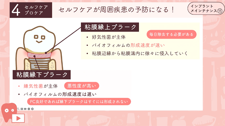 インプラントメインテナンス"