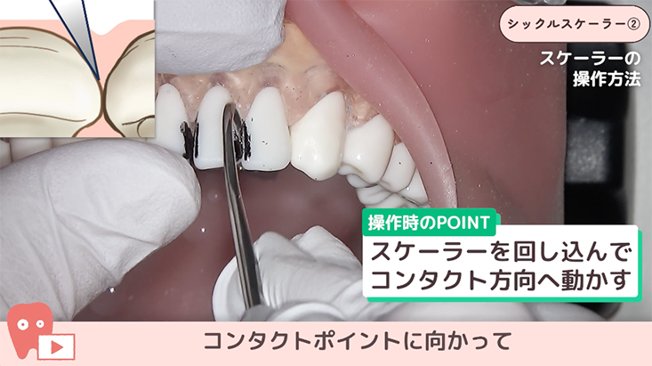 シックルスケーラー"