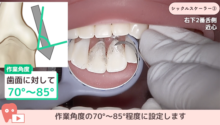 シックルスケーラー"