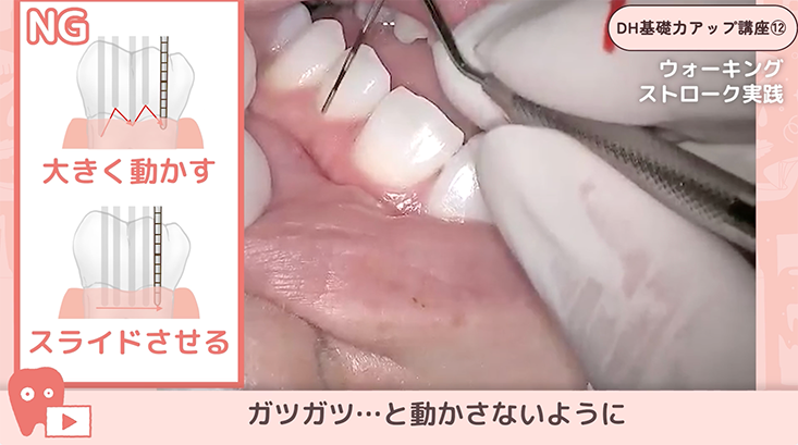 12.プロービング③-プローブの挿入とストローク-