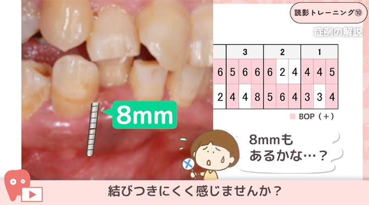 10.歯周検査前の読影