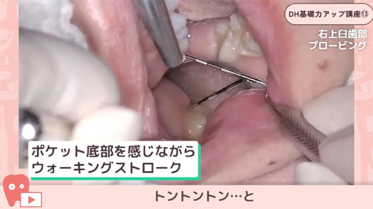 13.プロービング④-上顎臼歯部のプロービング-