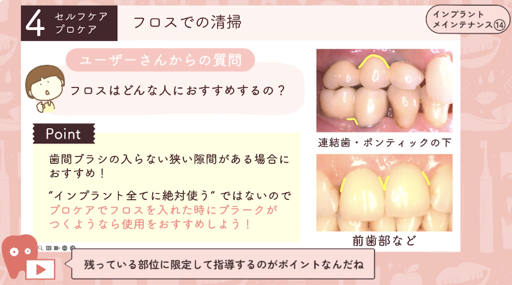 14.インプラントケア編④-フロス・その他の清掃器具-