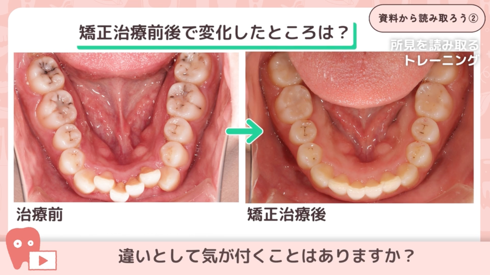 02.矯正治療における変化