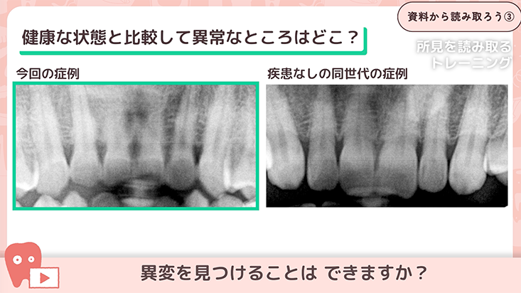 03.歯質の変化