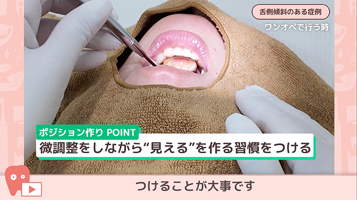 03.下顎前歯部の超音波スケーリング -実践編-