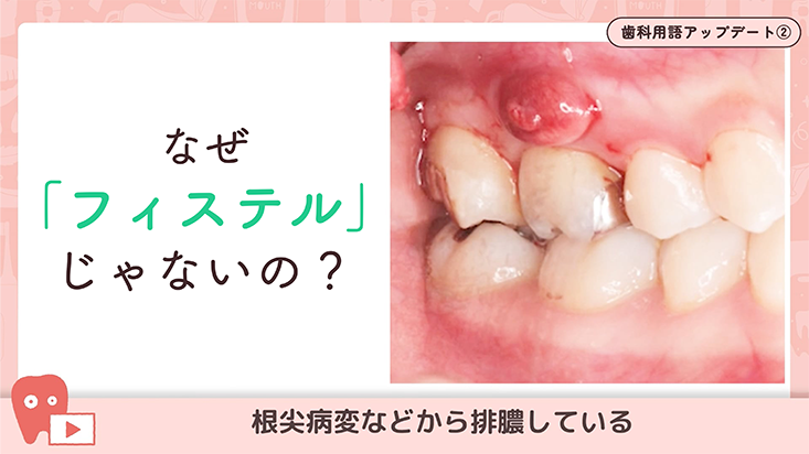 02.フィステル→サイナストラクト