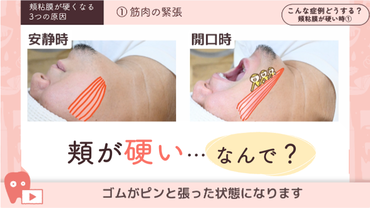 04.頬粘膜が硬い方への対応 -頬が硬くなる原因-